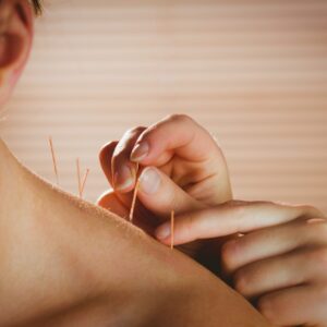 Image of woman receiving acupuncture at The Body Bar